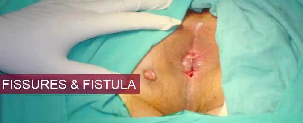 Fissures & Fistula