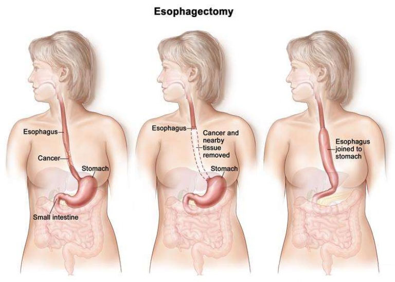 Oesophagus Surgery